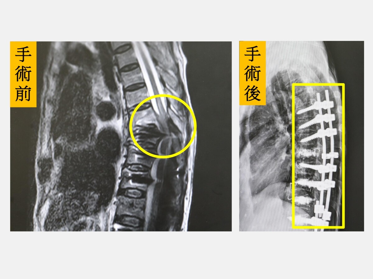▲左圖：第七胸椎發生爆裂性骨折且壓迫到脊髓(圓圈處)；右圖：完成脊椎長節手術(方框處)。(圖/大里仁愛醫院提供)