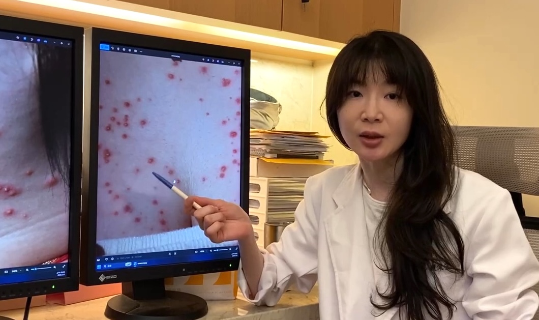 台中妙齡女因錯用類固醇藥膏治療胸口濕疹  引發全身性毛囊炎