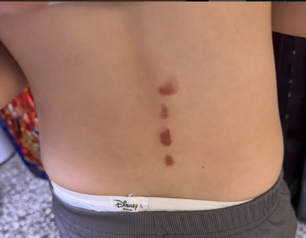 ▲暴力舉動導致女童背部挫傷。（圖／新北市議員劉美芳服務處提供）