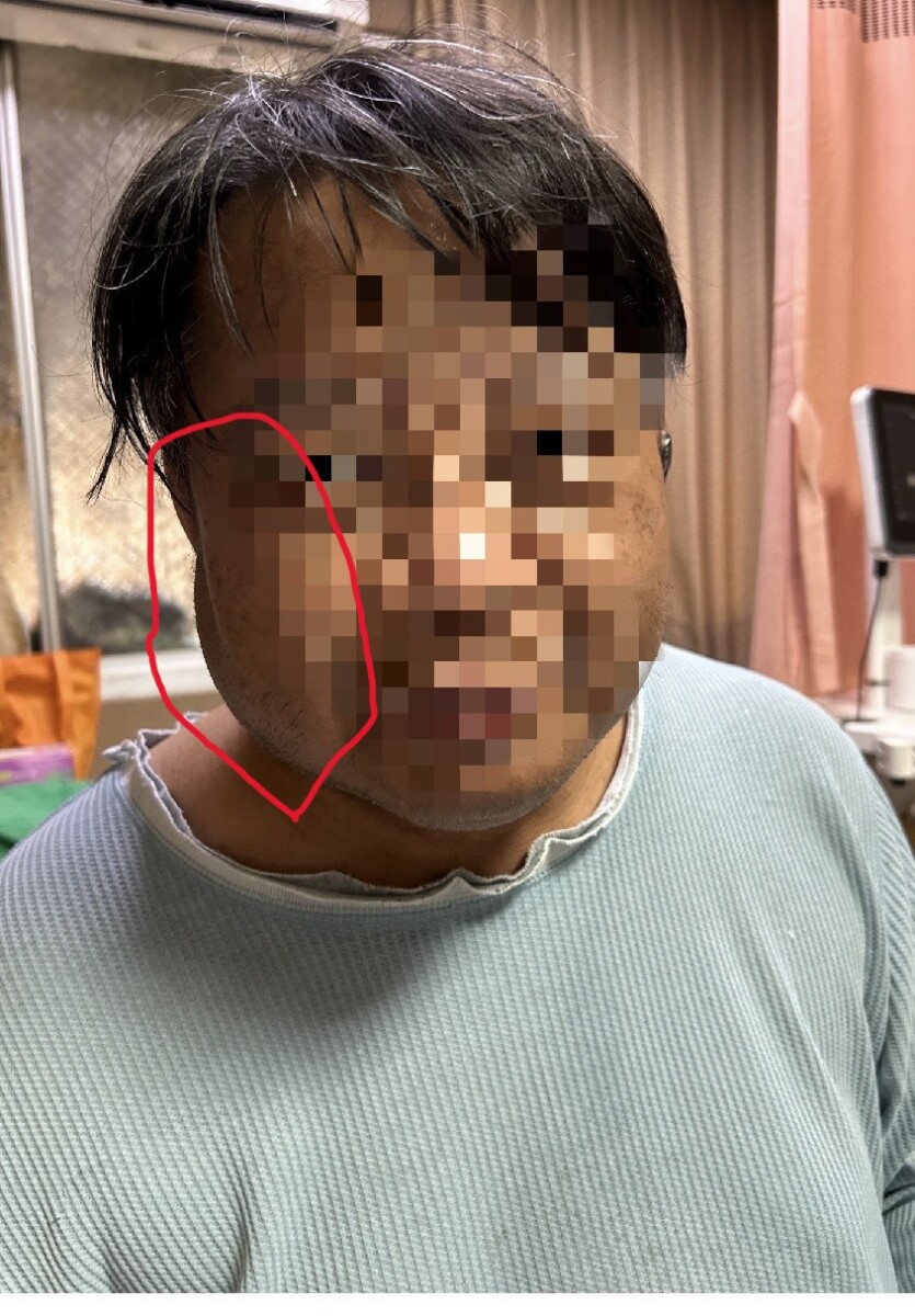 SQ07317 8員榮突破血管阻塞救回透析命脈